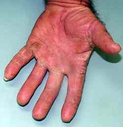 Hand Fungus