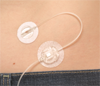 Sure-T by Medtronic