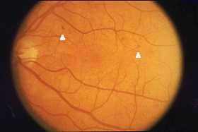 Photo of background diabetic retinopathy from the National Eye Institute 