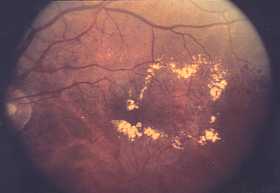 Photo of macular edema from the National Eye Institute 