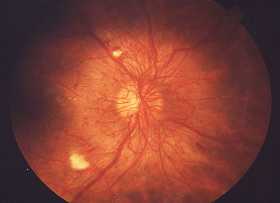 Photo of proliferative diabetic retinopathy from the National Eye Institute.