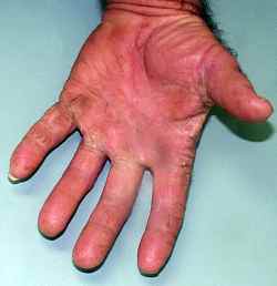 Fungus Infection in Diabetes