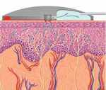 Glucose Sensor Patch