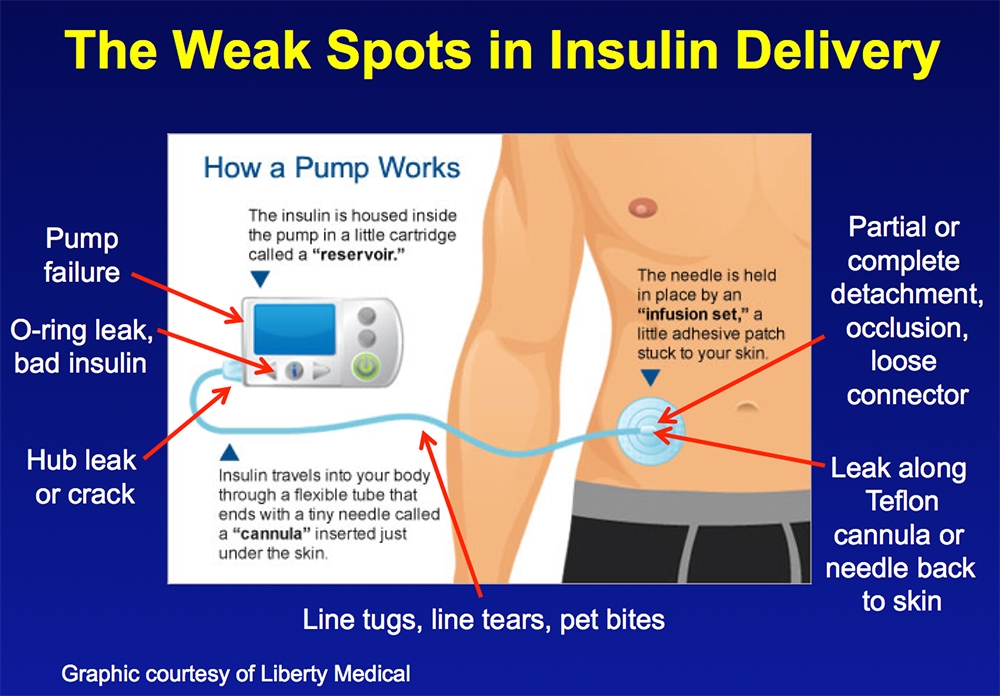 What is an insulin pump? 